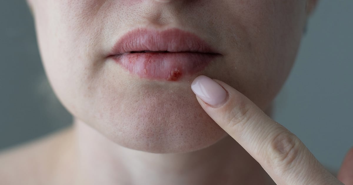 Aprobaron en Estados Unidos un antiviral oral inédito en casi 30 años para el herpes que no responde a los tratamientos habituales