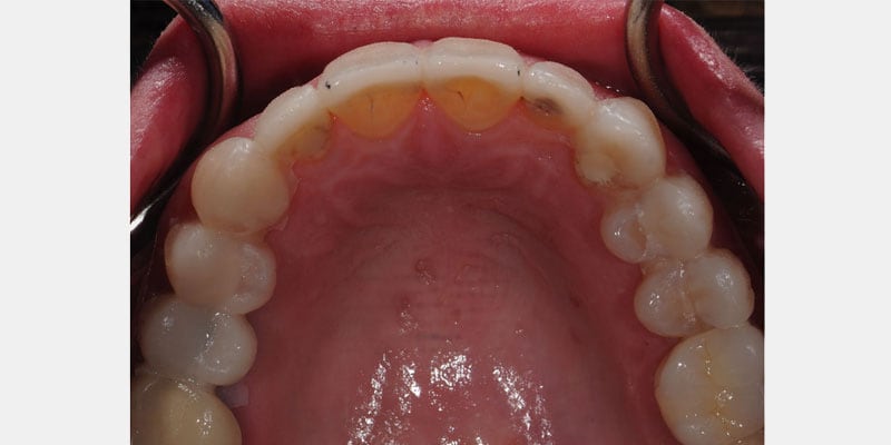 Carillas dentales: las filtraciones silenciosas que pueden arruinar una sonrisa y cómo descubrirlas a tiempo